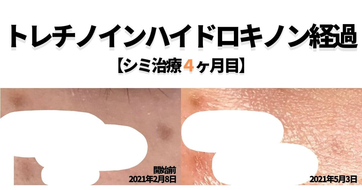 トレチノインハイドロキノンの経過を当ブログでご覧あれ