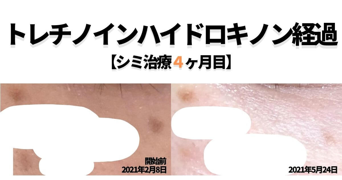 トレチノインハイドロキノンの経過を当ブログでご覧あれ