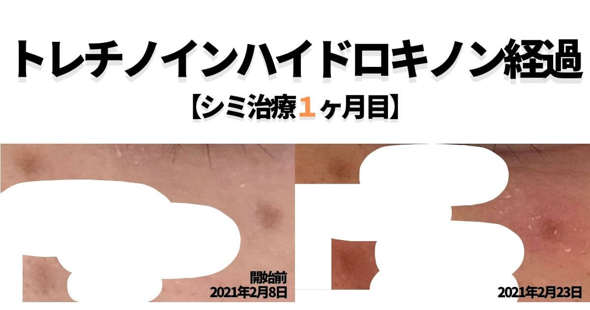 トレチノインハイドロキノンの経過を当ブログでご覧あれ